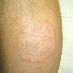 tinea gamba